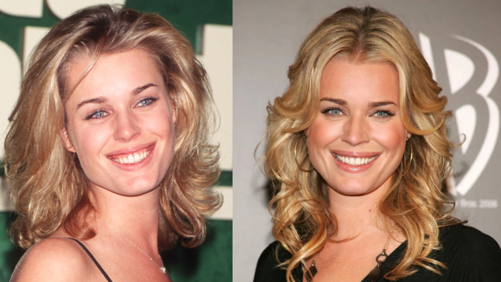 Rebecca Romijn Plastic Surgery