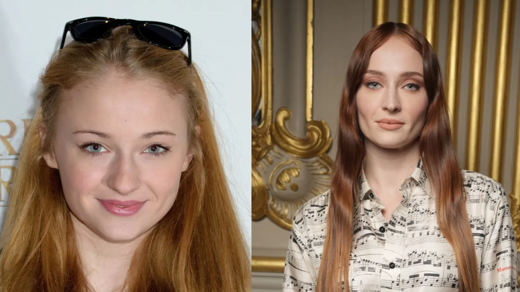 Sophie Turner Plastic Surgery