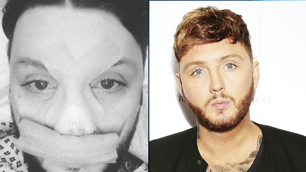 James Arthur Plastic Surgery