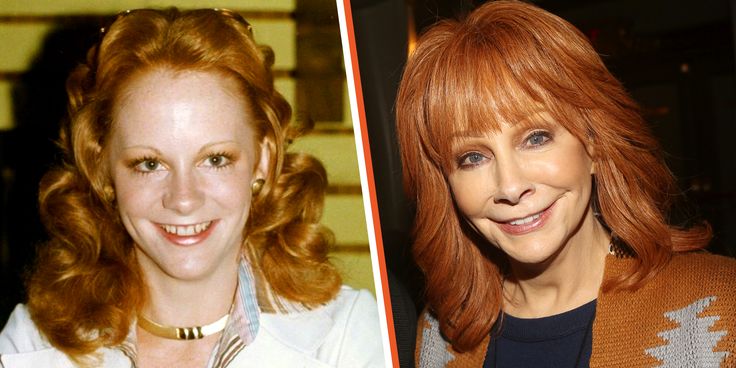 Reba McEntire Plastic Surgery: "Has Reba McEntire Had Plastic Surgery? 