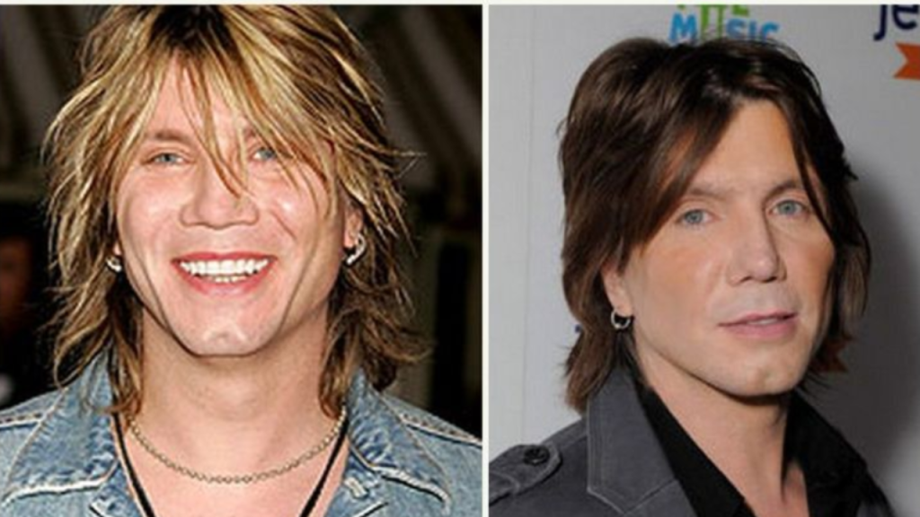 johnny rzeznik plastic surgery