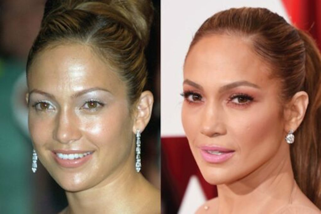 Jennifer Lopez Plastic Surgery: Has She Done Any Plastic Surgery?