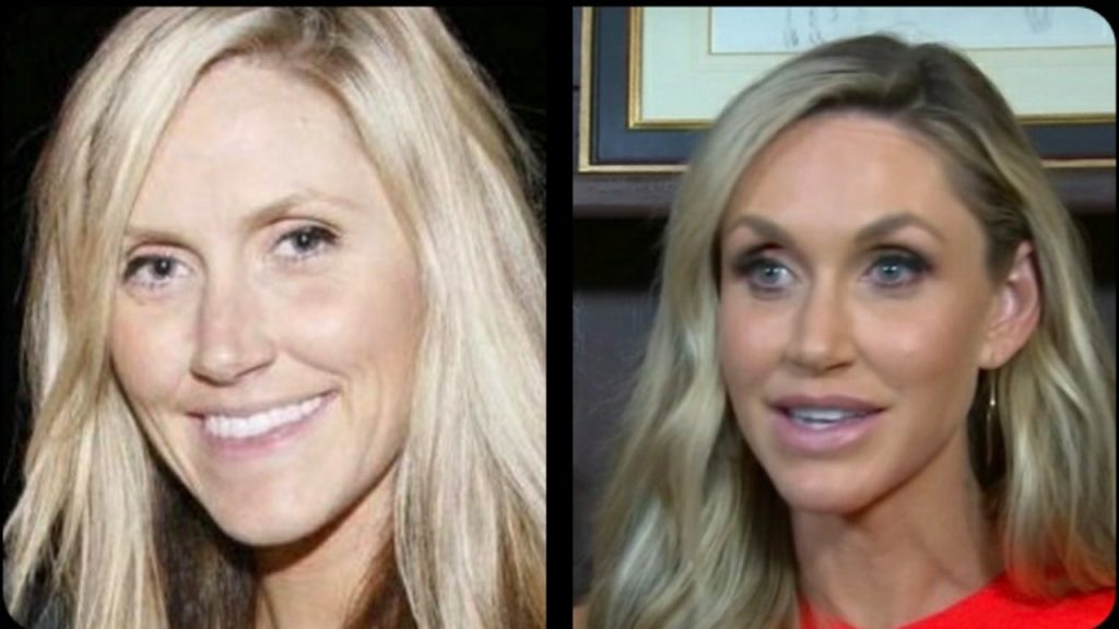 Lara Trump Plastic Surgery: Did She Get Plastic Surgery? 