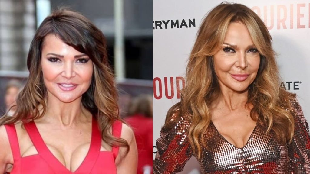 Lizzie Cundy Plastic Surgery: What Type of Surgeries Has She Done?