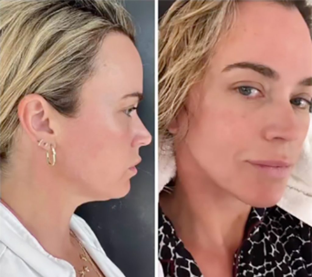 Teddi Mellencamp Plastic Surgery: She Want to Transparent About Her Surgery!