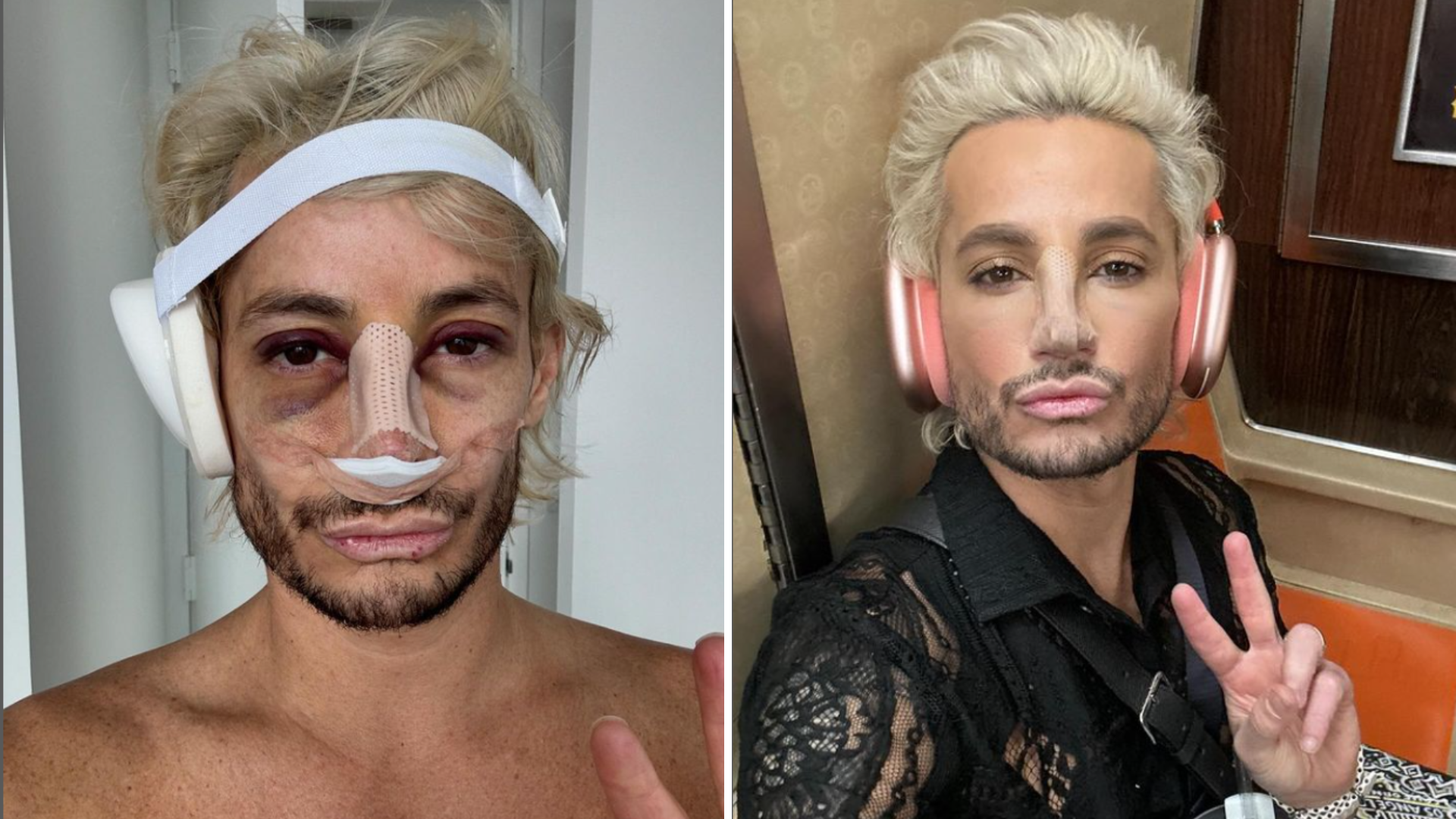 Frankie Grande Reveals Dramatic Post-Surgery Look: 'New Nose. Who Dis?